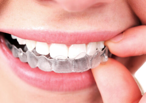 Invisalign® Clear Aligners