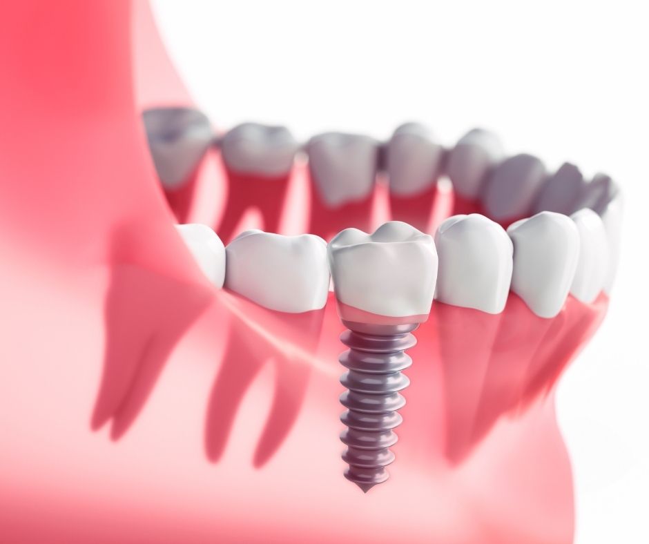 Dental Implants