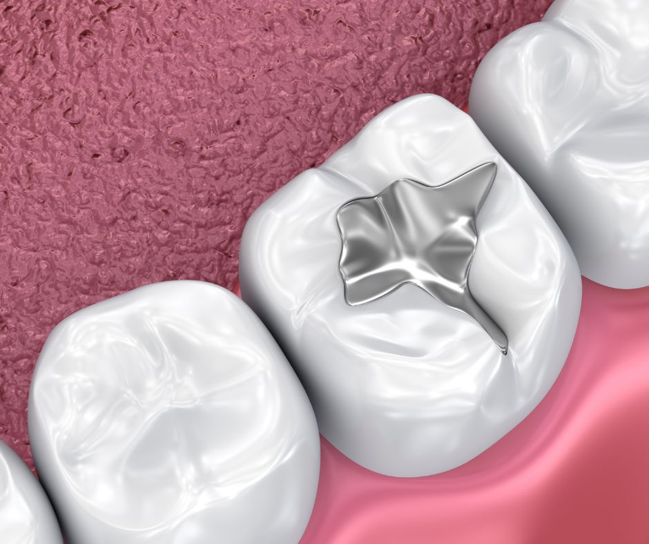 Dental Sealants