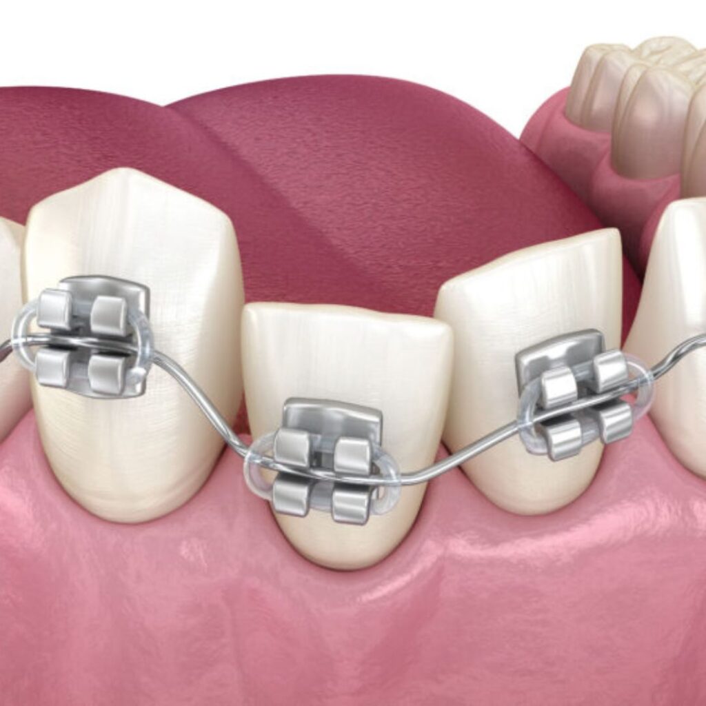 Malocclusions