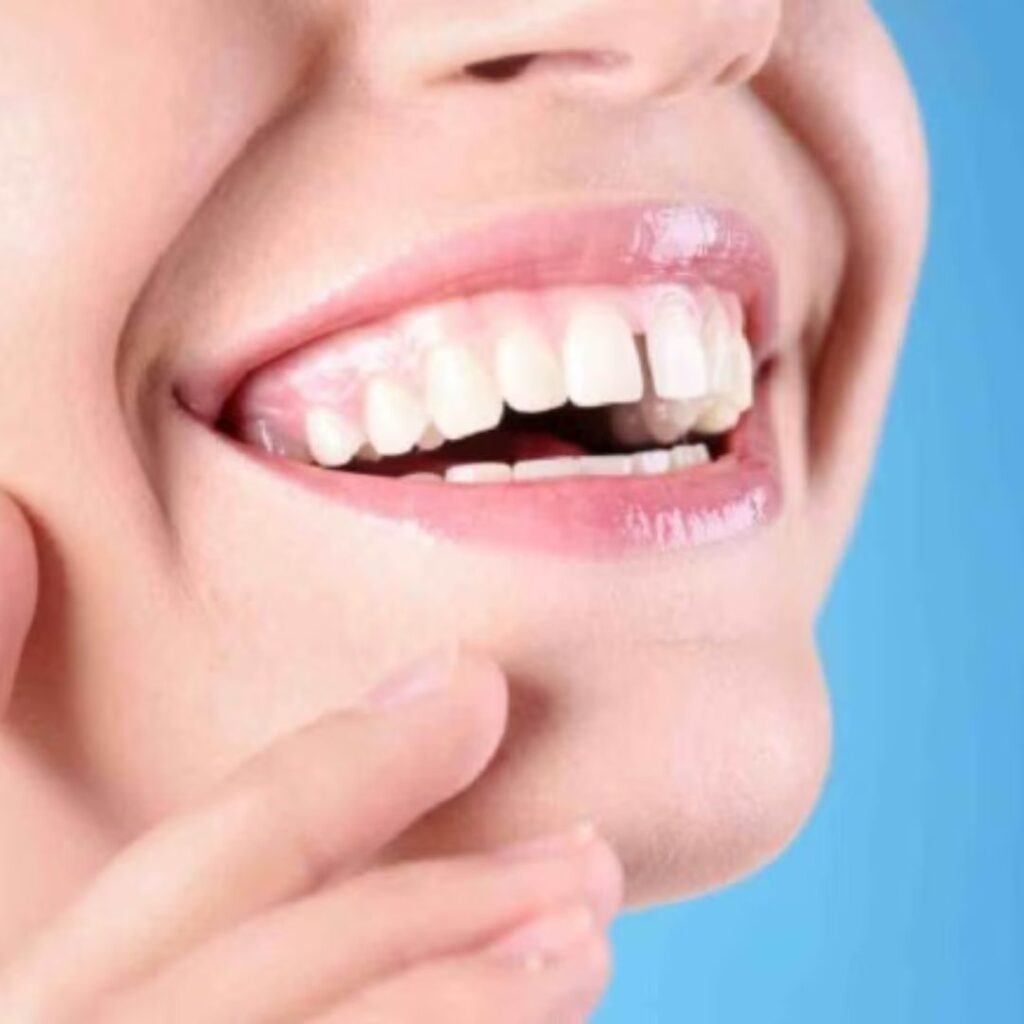 Gap between teeth